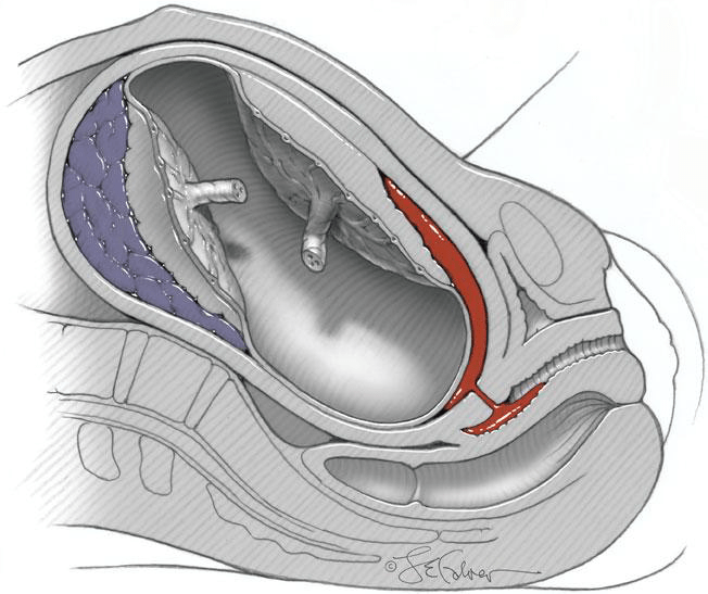 Abruptio placentae