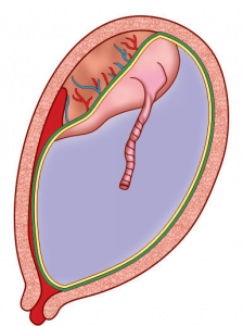 ABRUPTIO PLACENTAE: TYPES, CLASSIFICATION, SIGNS, PREVENTION AND ...