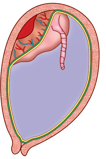 abruptio-placentae-types-classification-signs-prevention-and