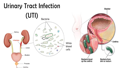 Infección del tracto urinario