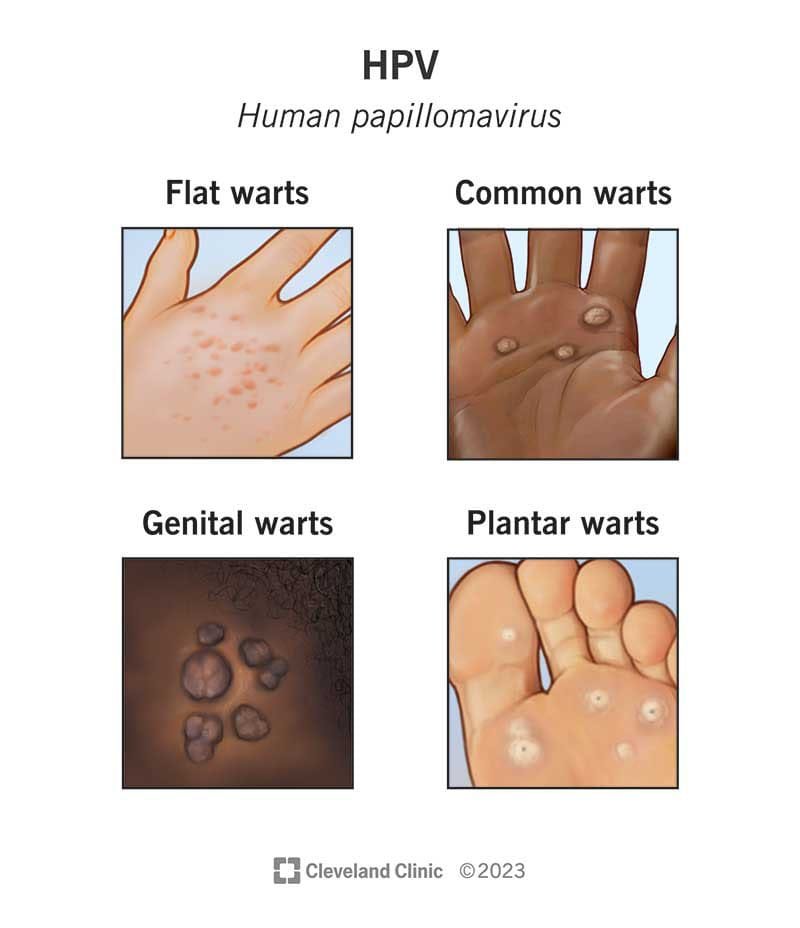 human papillomavirus