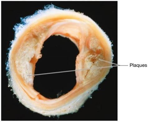 Plaques in Atherosclerosis